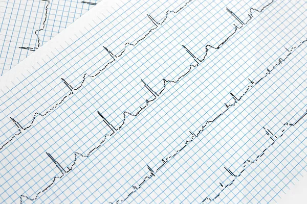 Elektrocardiogram op papier — Stockfoto