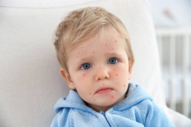 Kırmızı sivilce evde küçük bir çocuk. Tavuk Pox'u kavramı