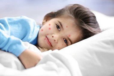 Little girl with red pimples lying in bed at home. Chicken pox concept clipart