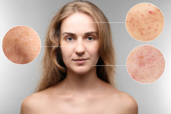 Conceito Acne Cuidados Com Pele Mulher Jovem Antes Depois Procedimento — Fotografia de Stock