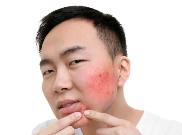 Skin care concept. Young man squeezing pimple, white background — Stock Photo, Image