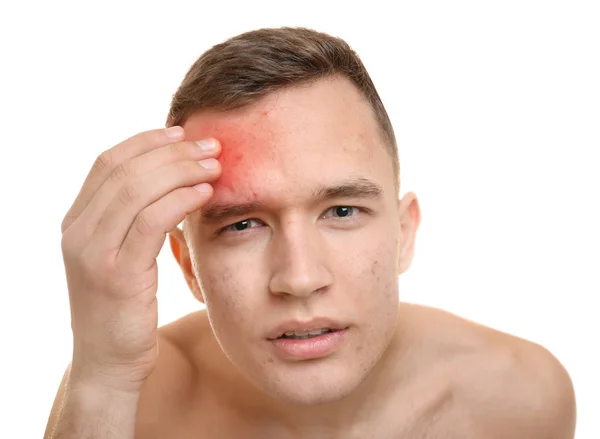 Conceito Cuidados Com Pele Jovem Com Acne Fundo Branco — Fotografia de Stock