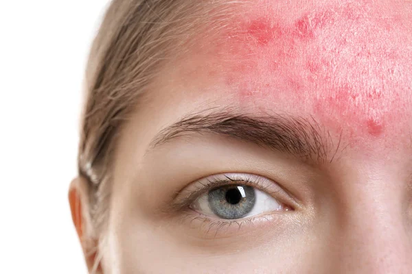 Conceito Cuidados Com Pele Jovem Com Acne Close — Fotografia de Stock