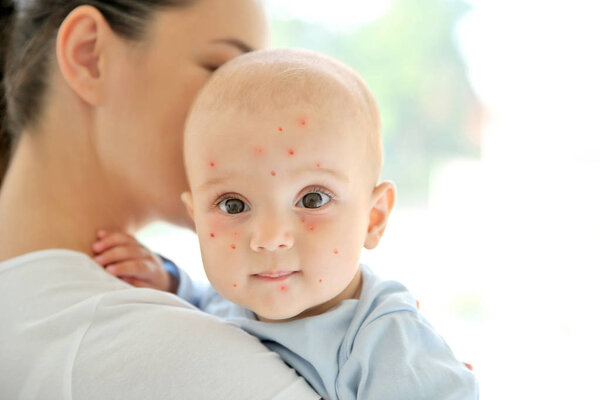 Mother holding little boy with red pimples at home. Chicken pox concept