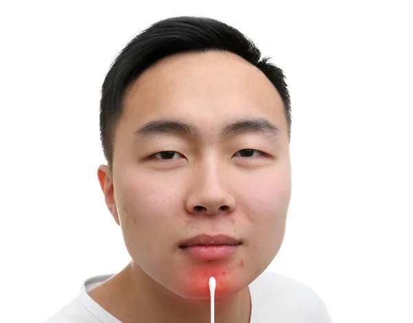 Hautpflegekonzept. junger Mann mit Akne auf weißem Hintergrund — Stockfoto