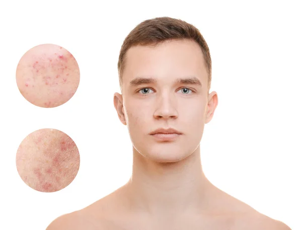 Acne Skin Care Concept Young Man Cosmetic Procedure White Background — Stock Photo, Image