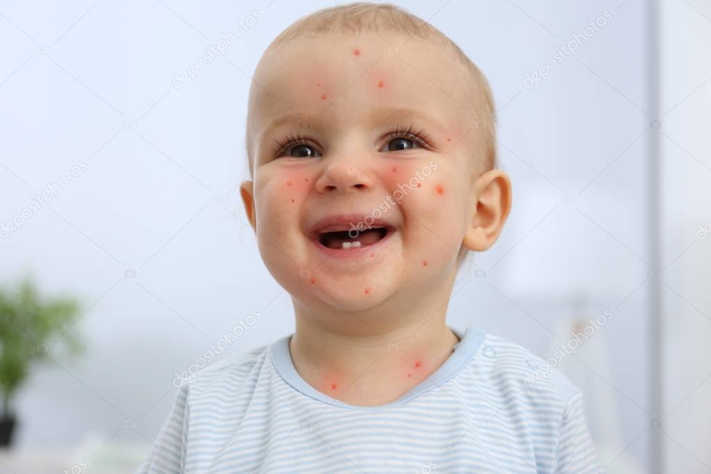Little boy with red pimples at home. Chicken pox concept