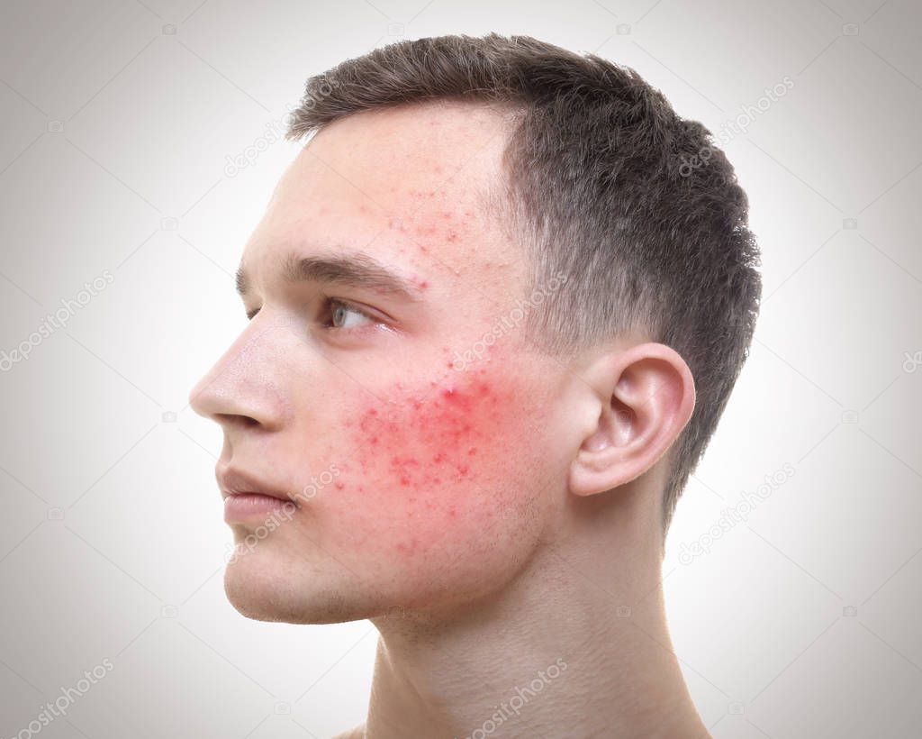 Skin care concept. Young man with acne on light background
