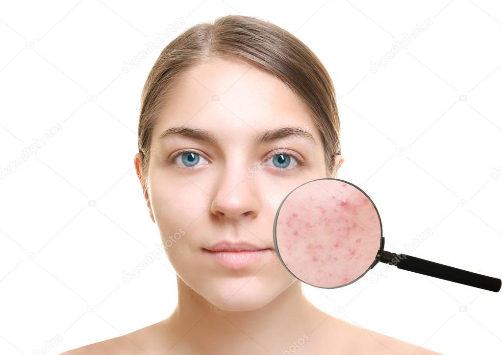 Acne and skin care concept. Young woman before and after cosmetic procedure on white background