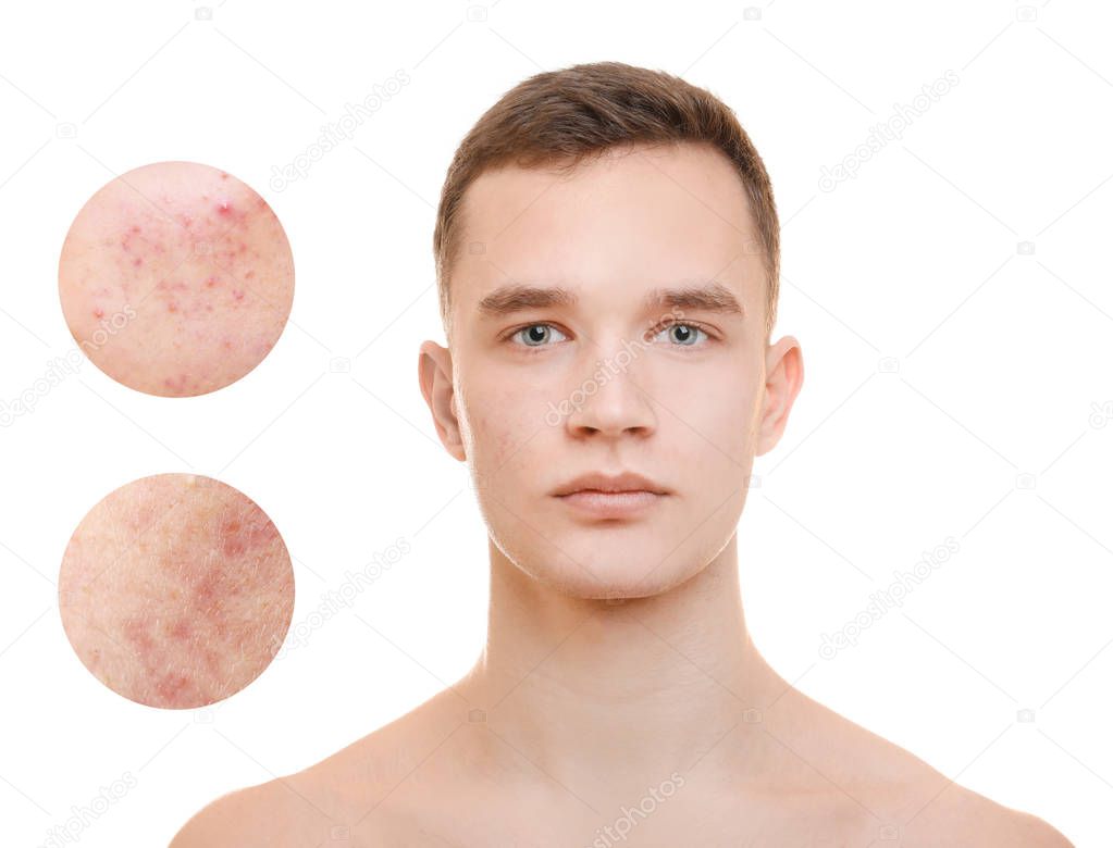Acne and skin care concept. Young man before and after cosmetic procedure on white background
