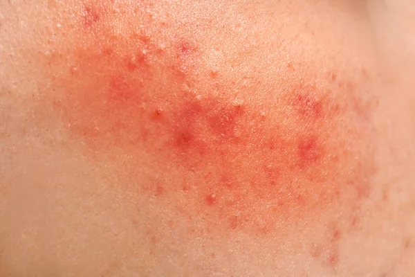 Concepto de tratamiento del acné — Foto de Stock