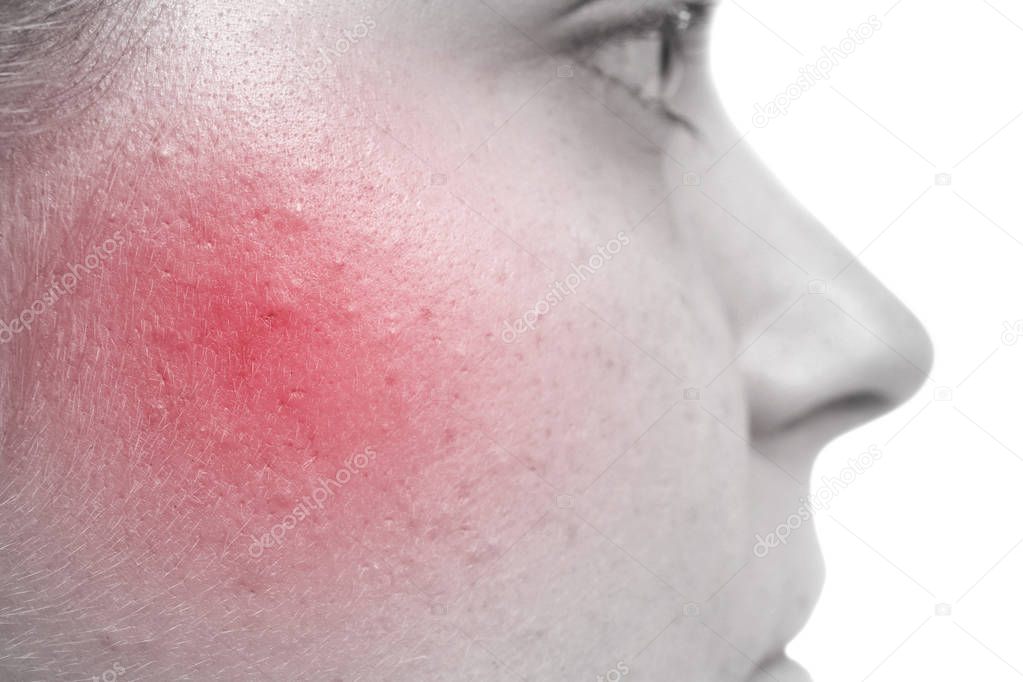Skin care concept. Young woman with acne, closeup