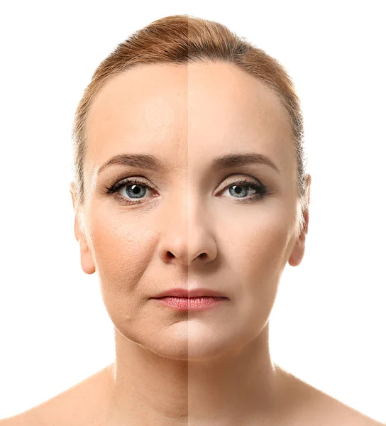 Gezicht vóór en na cosmetische ingreep — Stockfoto