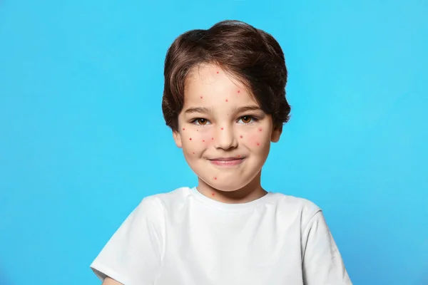 Niño pequeño con granos rojos sobre fondo azul. Concepto de varicela — Foto de Stock