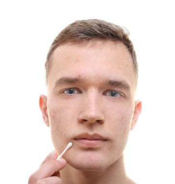 Beyaz arka plan üzerinde sorun cilt ve pamuk bud ile yakışıklı genç