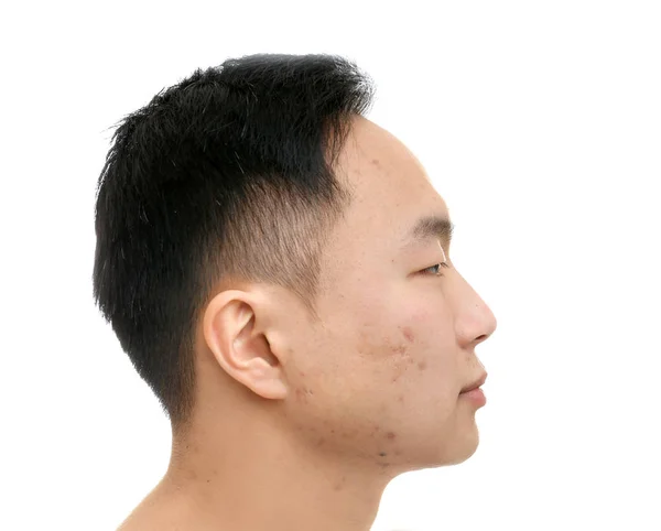 Young Asian man with problem skin on white background — Stock Photo, Image