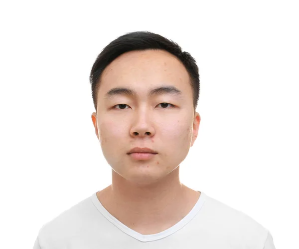 Young Asian man with problem skin on white background — Stock Photo, Image