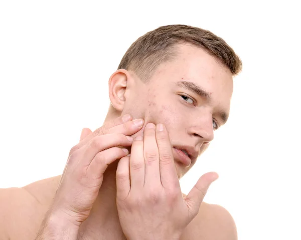 Beau Jeune Homme Avec Peau Problème Sur Fond Blanc — Photo