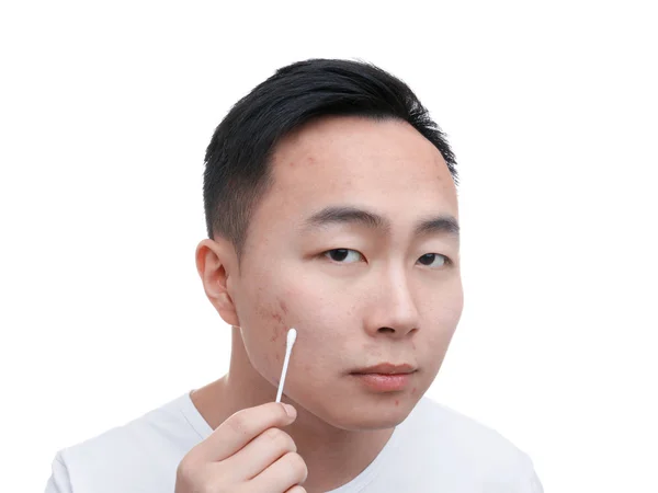 Jeune homme asiatique avec problème de peau et de coton bourgeon sur fond blanc — Photo