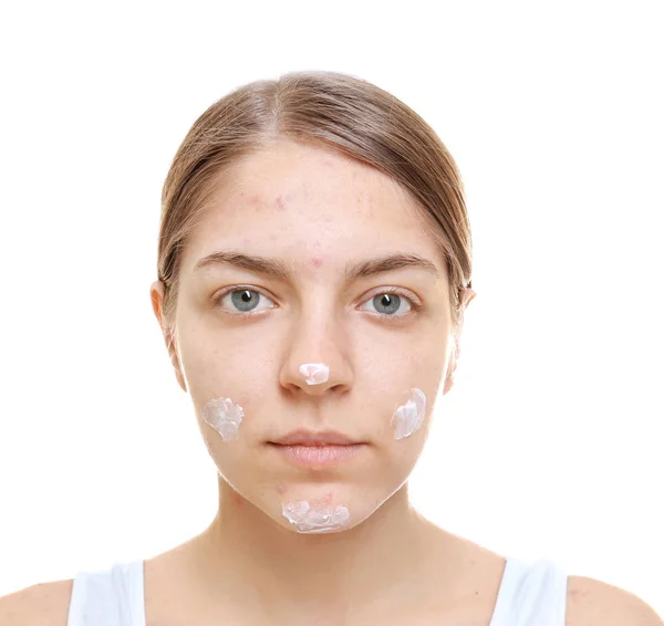 Gyönyörű Fiatal Problémás Bőr Arc Fehér Háttér Alkalmazott Krém — Stock Fotó