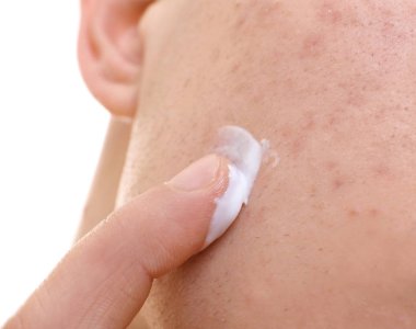 Genç adam için sorun deri yüz, closeup üzerine krem uygulamak