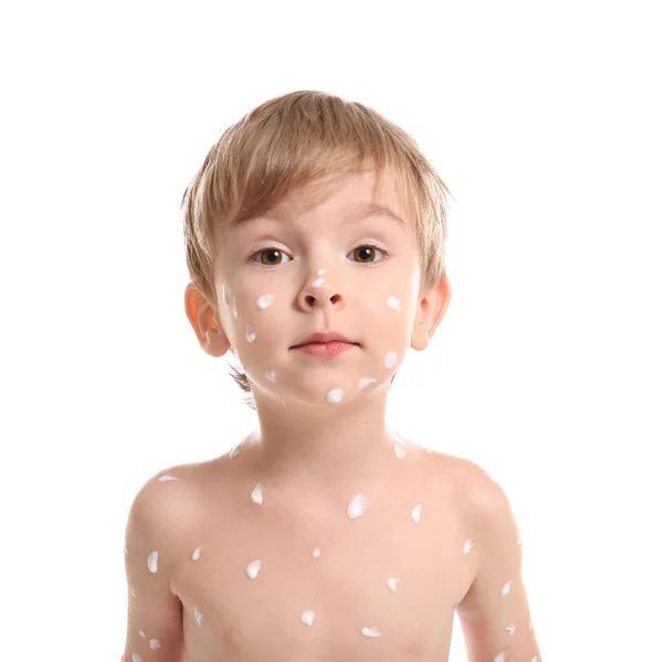 Menino bonito com varicela — Fotografia de Stock