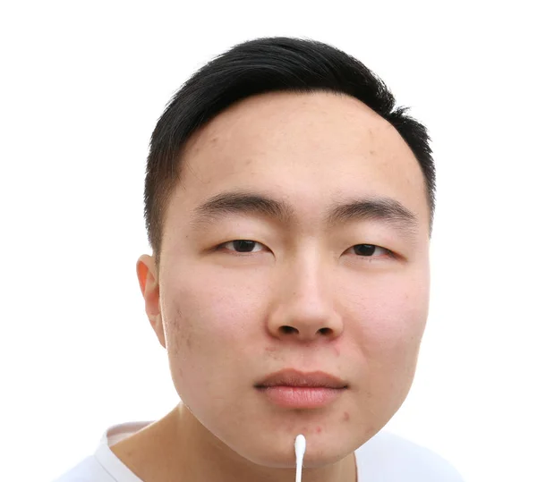 Junger asiatischer Mann mit Problemhaut und Wattestäbchen auf weißem Hintergrund — Stockfoto