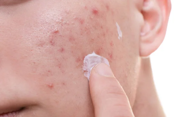 Hombre joven aplicando crema para problemas de piel en la cara, primer plano —  Fotos de Stock