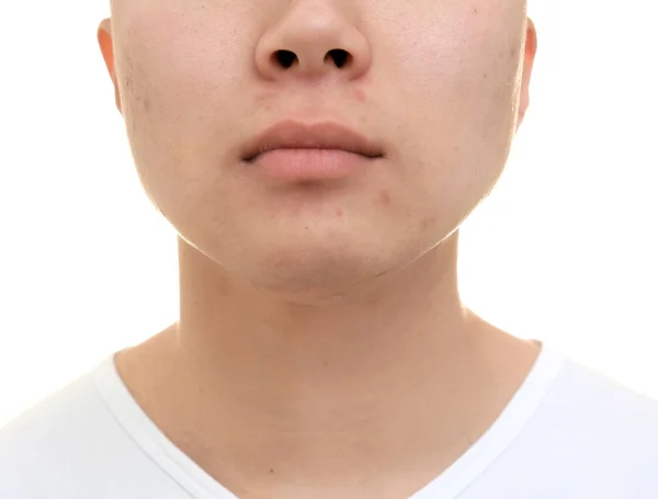 Hombre joven guapo con piel problemática sobre fondo blanco, primer plano — Foto de Stock