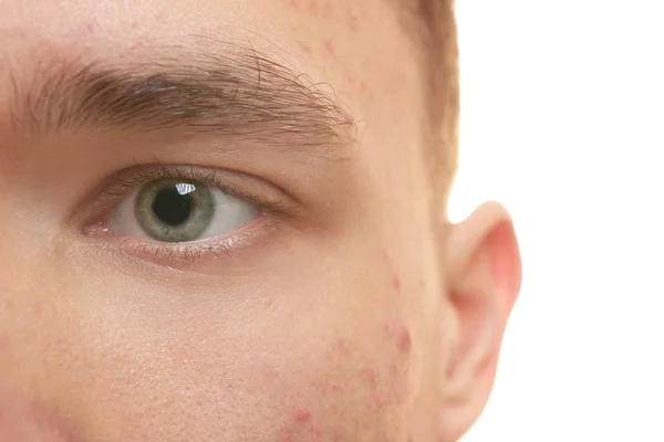 Face Handsome Young Man Problem Skin Closeup — Stock Photo, Image