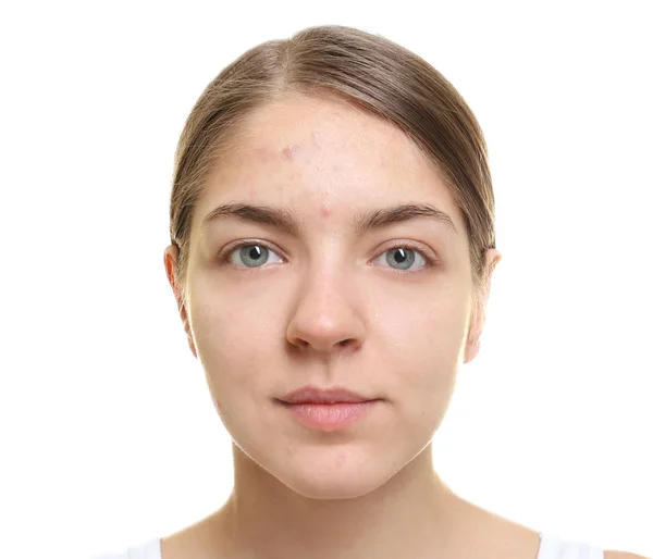 Woman with problem skin — Stock Photo, Image