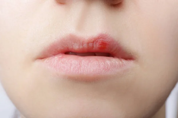 Lippen von Lippenherpes betroffen — Stockfoto