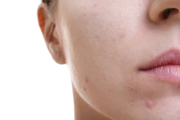 Woman with problem skin — Stock Photo, Image