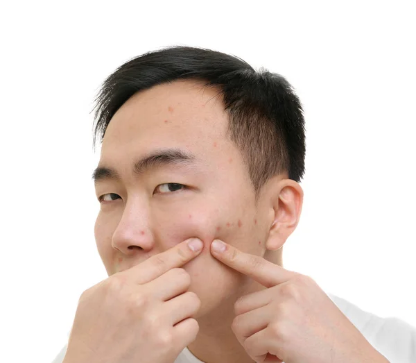 Young Asian man popping pimples, on white background — Stock Photo, Image