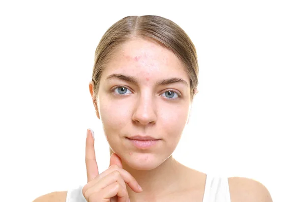 Mooie Jonge Vrouw Crème Voor Probleem Huid Gezicht Toe Passen — Stockfoto