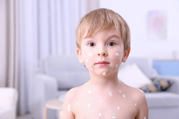 Menino bonito com varicela — Fotografia de Stock