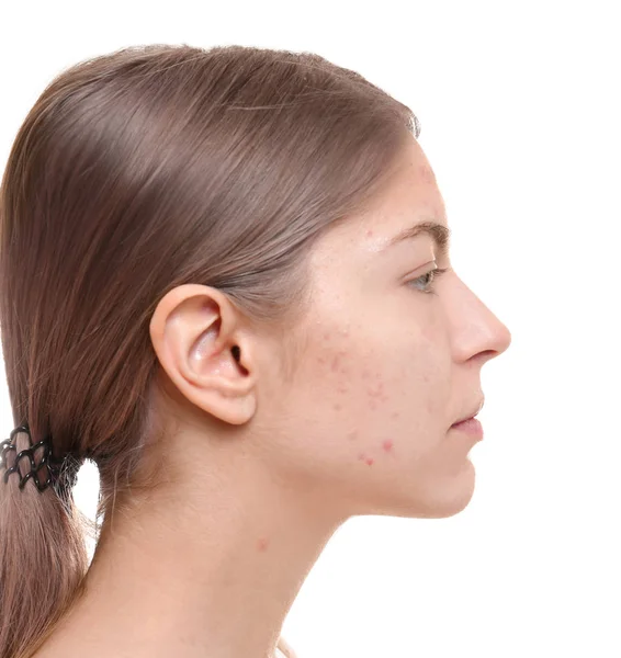 Woman with problem skin — Stock Photo, Image