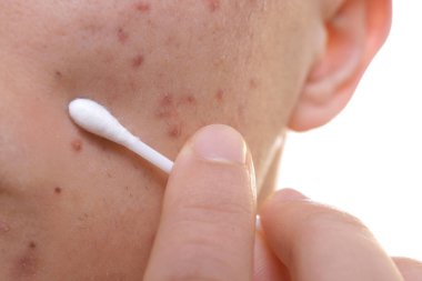 Sorun cilt ve pamuk bud, closeup ile genç adam