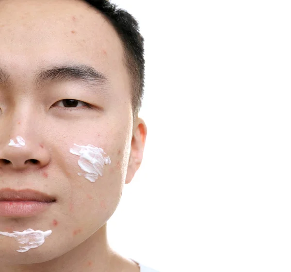 Jeune homme asiatique avec de la crème pour la peau de problème appliquée sur le visage, sur fond blanc — Photo