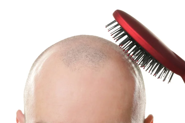 Έννοια απώλεια μαλλιών. Νεαρός άνδρας με μαλλιά χτένα σε λευκό φόντο — Φωτογραφία Αρχείου