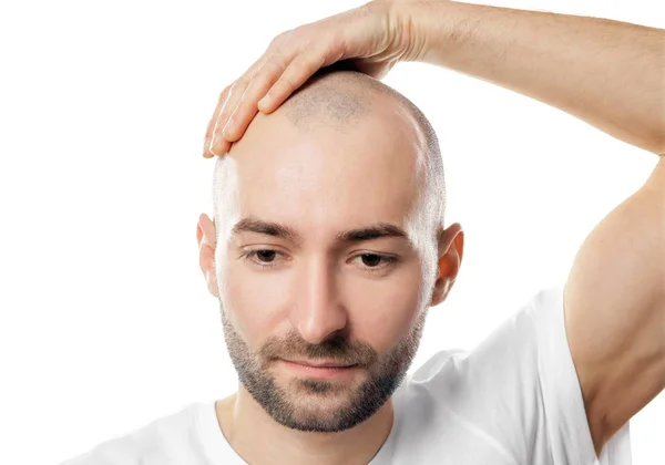 Concepto de pérdida de cabello. Hombre tocando su calva cabeza sobre fondo blanco —  Fotos de Stock