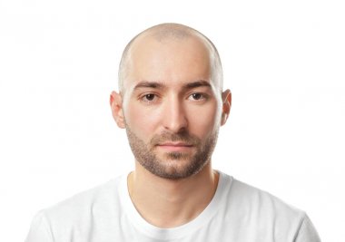 Saç kaybı kavramı. Beyaz arka plan üzerinde genç kel adam portresi