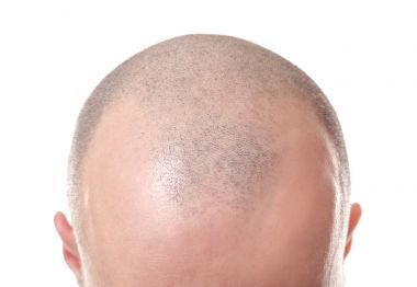 Hair loss concept. Head of man on white background, closeup clipart