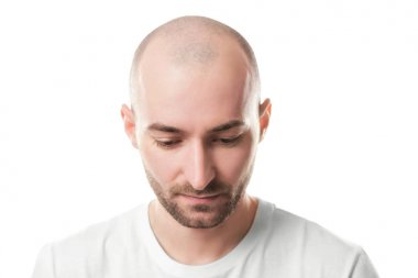 Saç kaybı kavramı. Beyaz arka plan üzerinde genç kel adam portresi