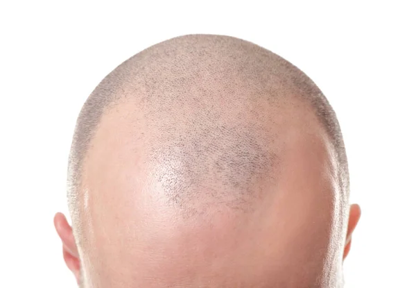 Hair loss concept. Head of man on white background, closeup — Stock Photo, Image