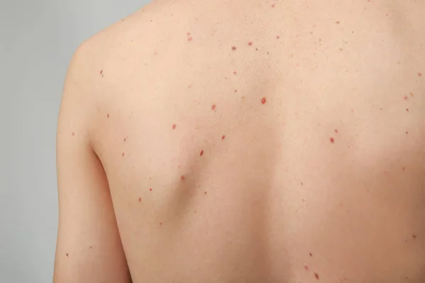 Birthmarks on human body — Stock Photo, Image