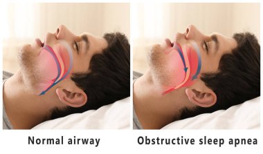 Snore problem concept. Illustration of normal airway and obstructive sleep apnea clipart