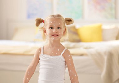 little girl with chickenpox  clipart