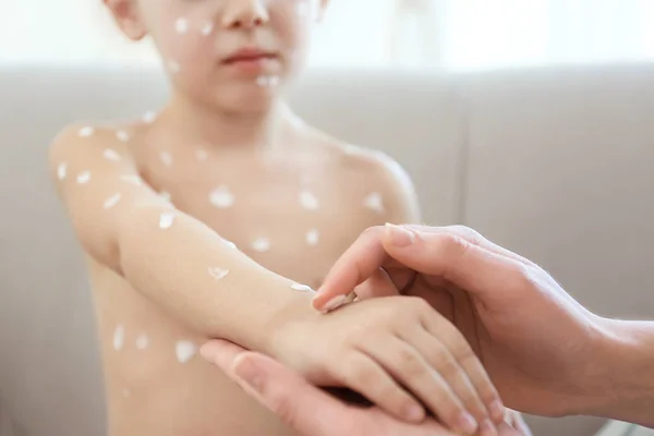 Criança doente com varicela — Fotografia de Stock