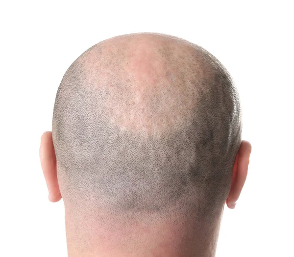 Mann mit Glatze — Stockfoto